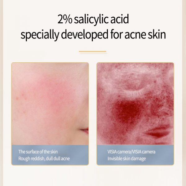 Acne Removing Salicylate Products - Image 2